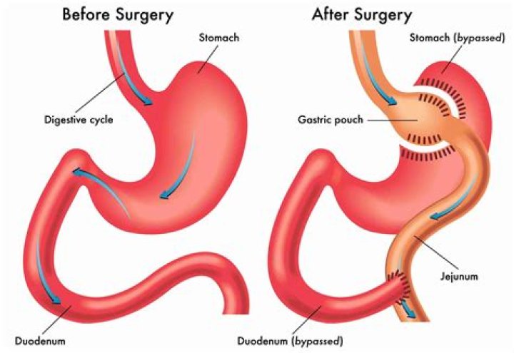 Can you do a gastric sleeve pouch reset years after surgery?