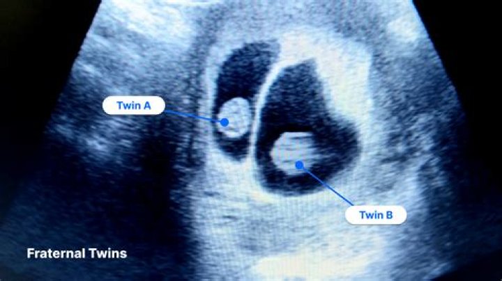 Can you have twins at 22?