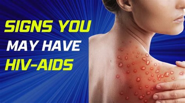 Do you legally have to tell someone you have AIDS?